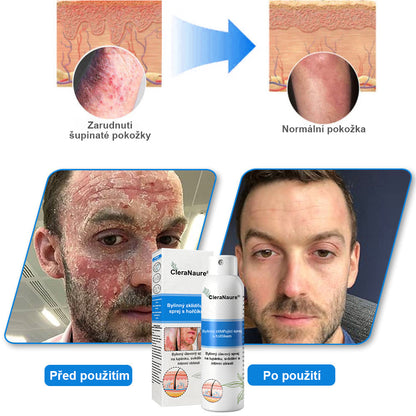 ⚠️🫧CleraNature® Hořčíkový Sprej – Rychlá Úleva pro Svědící, Červenou a Citlivou Pokožku (Dokonce i Intimní Oblasti)